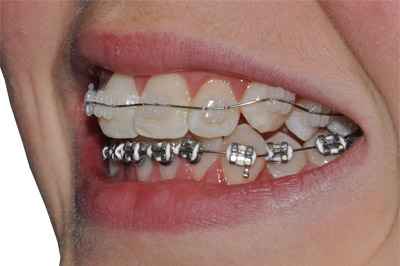 Braces on one of our patients in Gordon